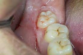 20’lik diş ağrısı nasıl geçer, ne iyi gelir? 20’lik diş ağrısı belirtileri nelerdir, boğaz ve baş ağrısı yapar mı?