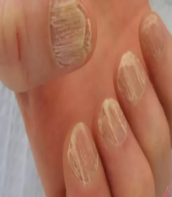 Tırnak mantarından kurtulmak isteyenlerin dikkatine!