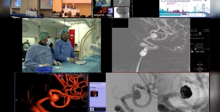 Malatya ekibi, İstanbul'da düzenlenen uluslararası toplantıda beyin baloncuğu tedavisini canlı yayınladı