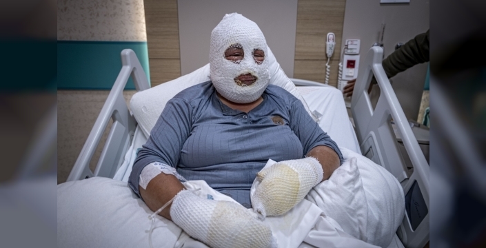 Ardahan'da yangında kızı için mücadele eden anne tedavi altında