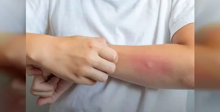 Egzama hastalığı, sosyal yaşamı olumsuz etkileyebiliyor